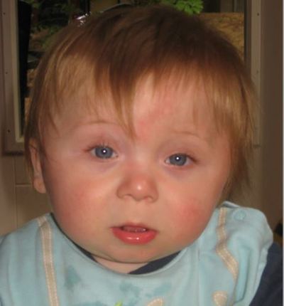 ADNP Syndrome awareness